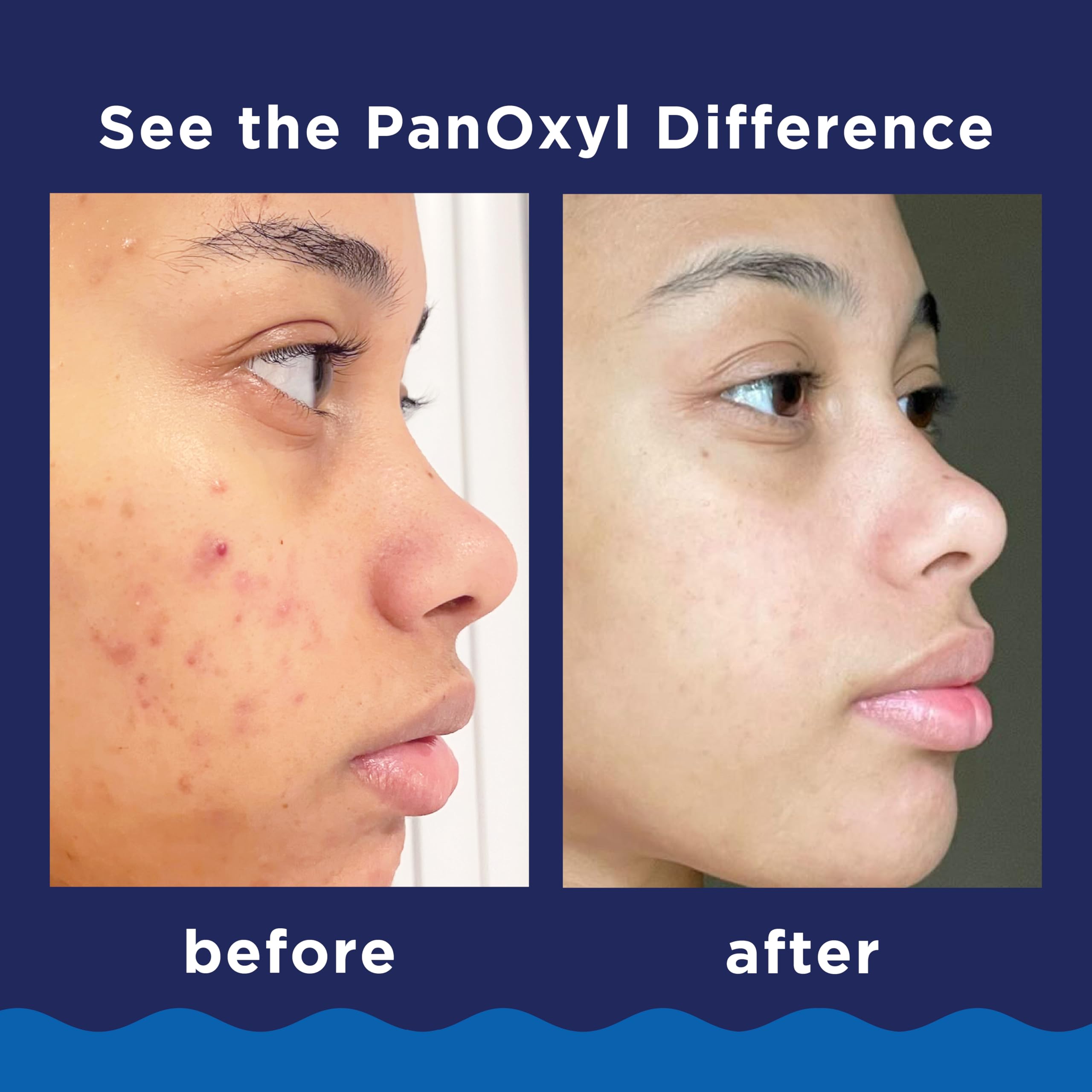PanOxyl 10% Benzoyl Peroxide Acne Foaming Wash, Maximum Strength, Daily Acne-Fighting Face and Body Cleanser, Face Wash to Clear, Treat and Prevent Acne Pimples and Stubborn Breakouts, 5.5 Oz Tube