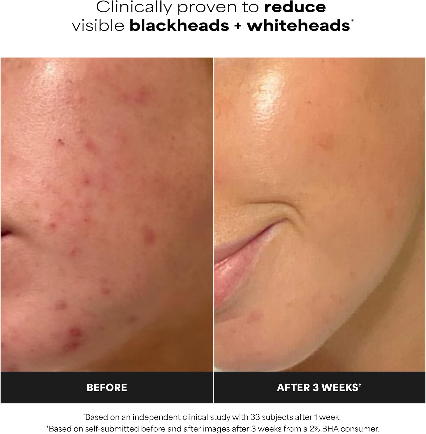 Paula's Choice SKIN PERFECTING 2% BHA Liquid Exfoliant, 30 mL, Travel Size