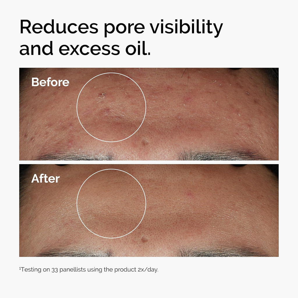 The Ordinary Niacinamide 10% + Zinc 1%, Brightening & Smoothing Serum for Blemish-Prone Skin